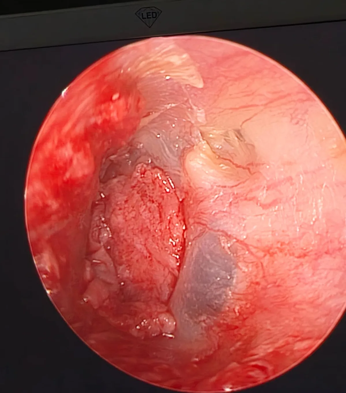 Otoscopia endoscópica do ouvido ao final de uma timpanoplastia