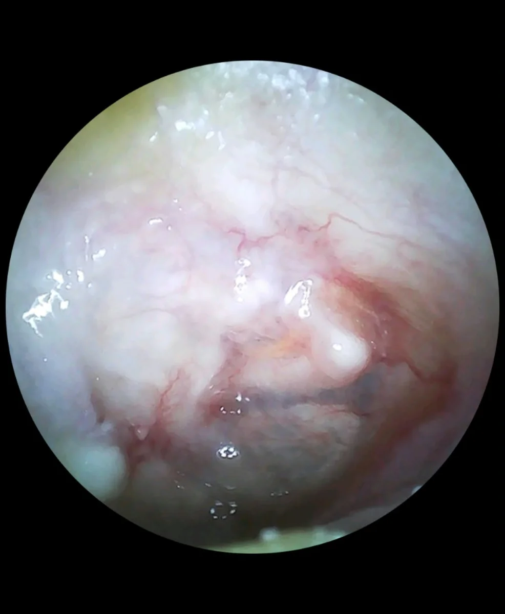 Otoscopia de acompanhamento de um ouvido operado de timpanoplastia
