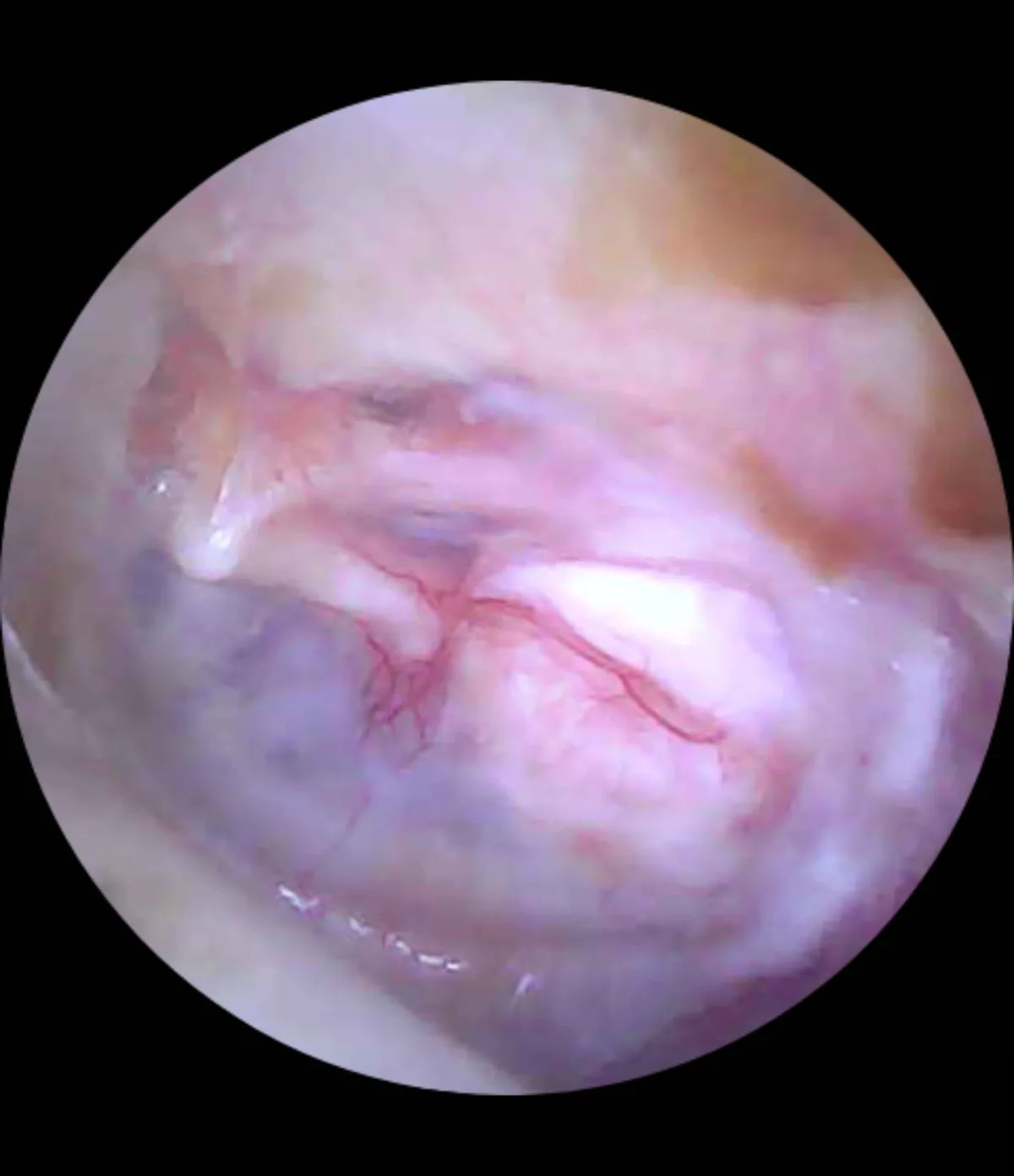 Otoscopia de acompanhamento mostrando o aspecto de uma timpanoplastia na fase tardia